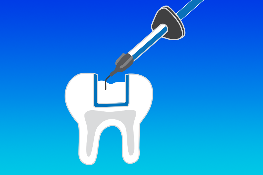 An illustration of flowable composite being extruded into a prepared tooth in a blue background