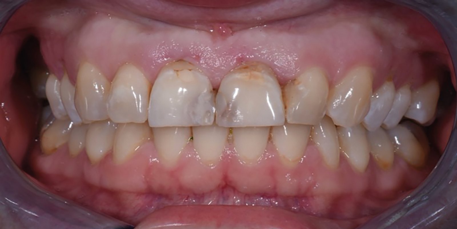 Case report Figur 1 bleking med Opalescence