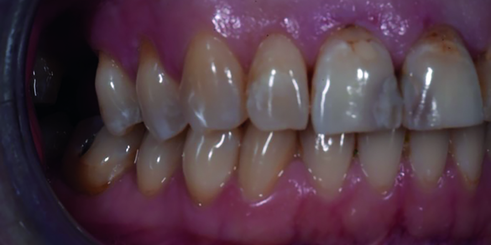 Case report Figur 3 bleking med Opalescence