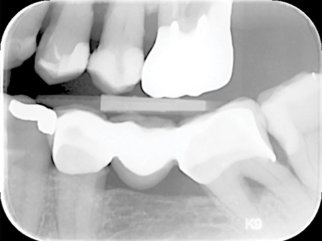 Equia Forte case Røntgenbilde Fig 8 Oppfølging-etter-6-år---Klinisk-testet.jpg