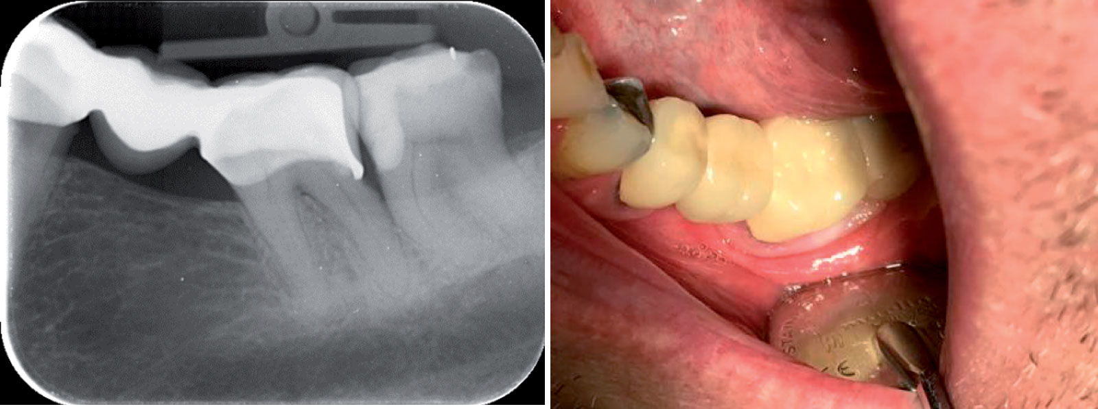 Fig-6-7 Equia Forte case