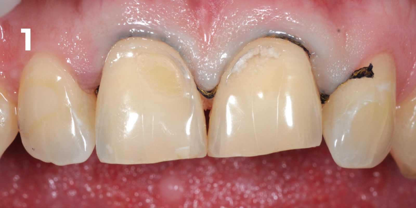 kuraray - panavia v5 - 1.png