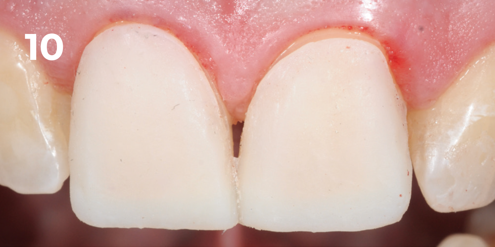 kuraray - panavia v5 - 10.png