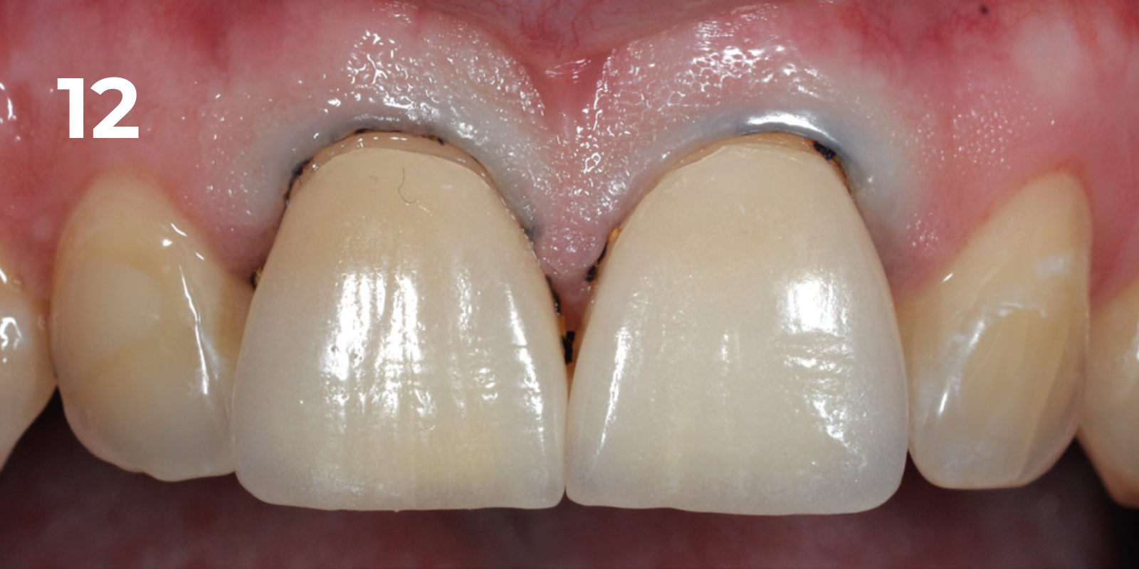 kuraray - panavia v5 - 12.png