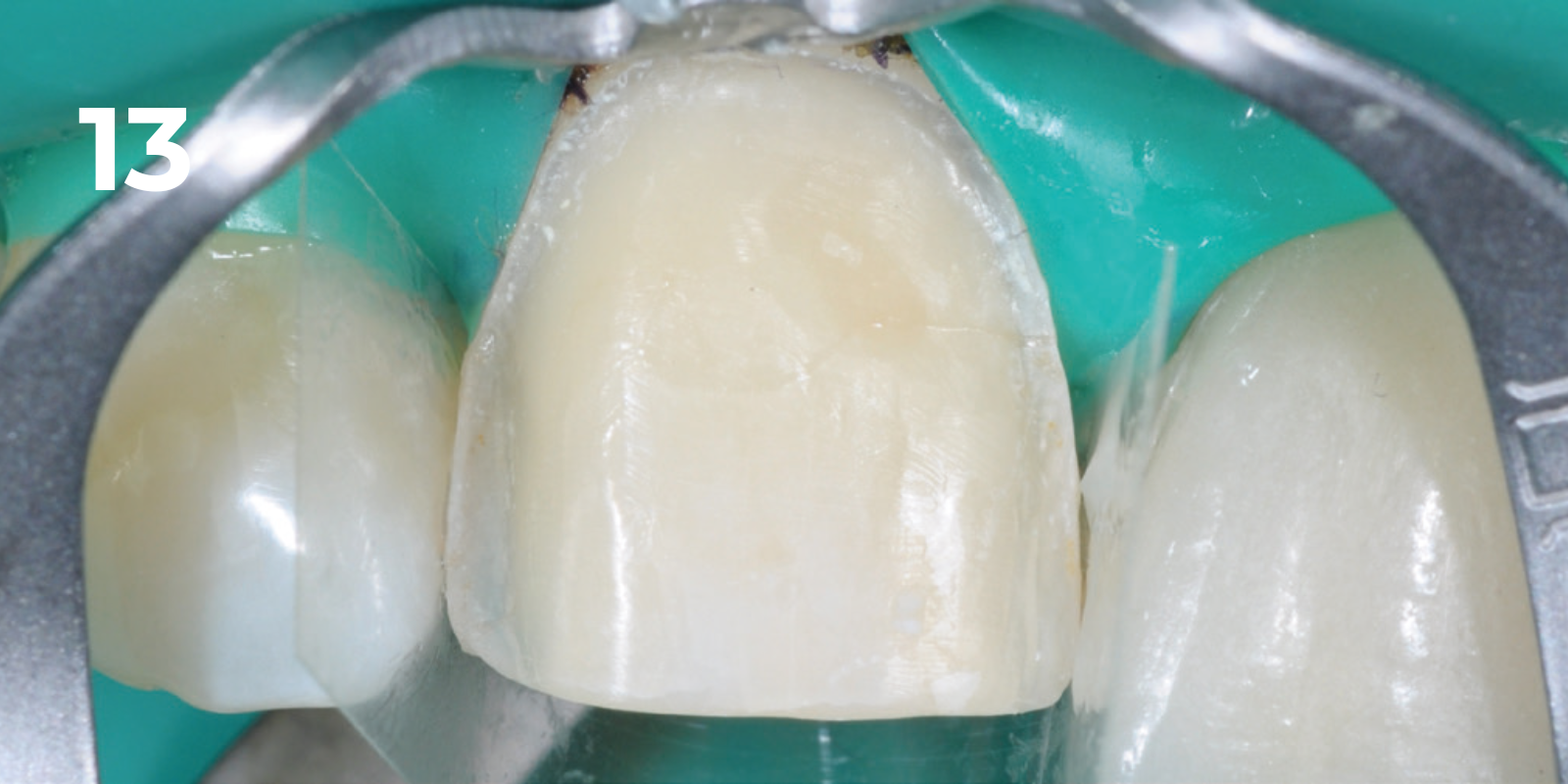 kuraray - panavia v5 - 13.png