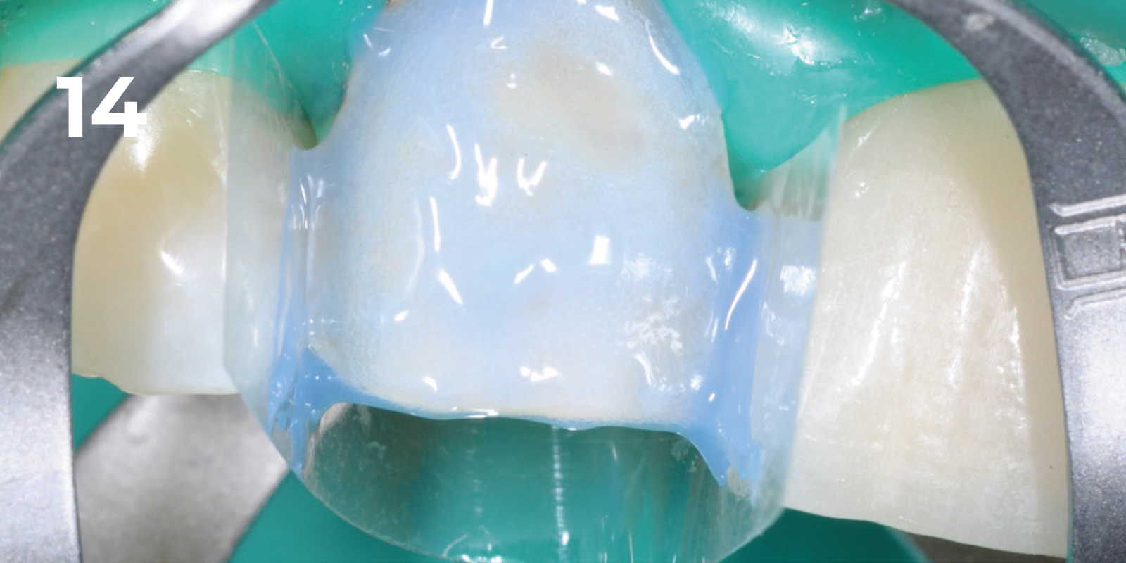 kuraray - panavia v5 - 14.png