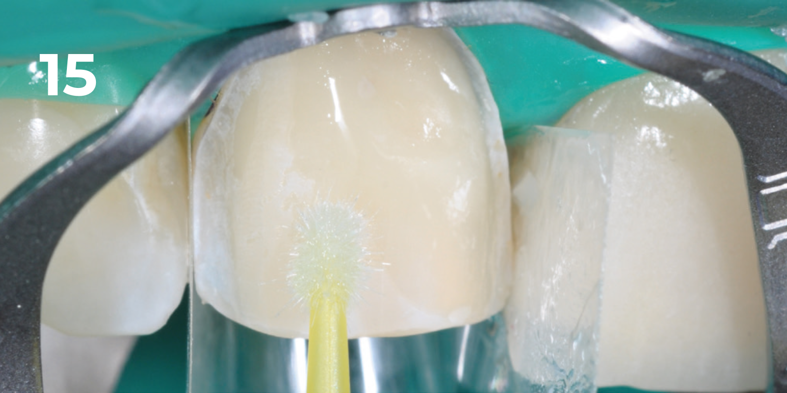 kuraray - panavia v5 - 15.png