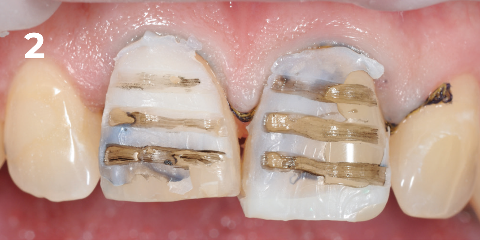 kuraray - panavia v5 - 2.png