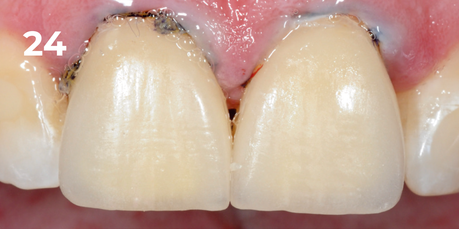 kuraray - panavia v5 - 24.png