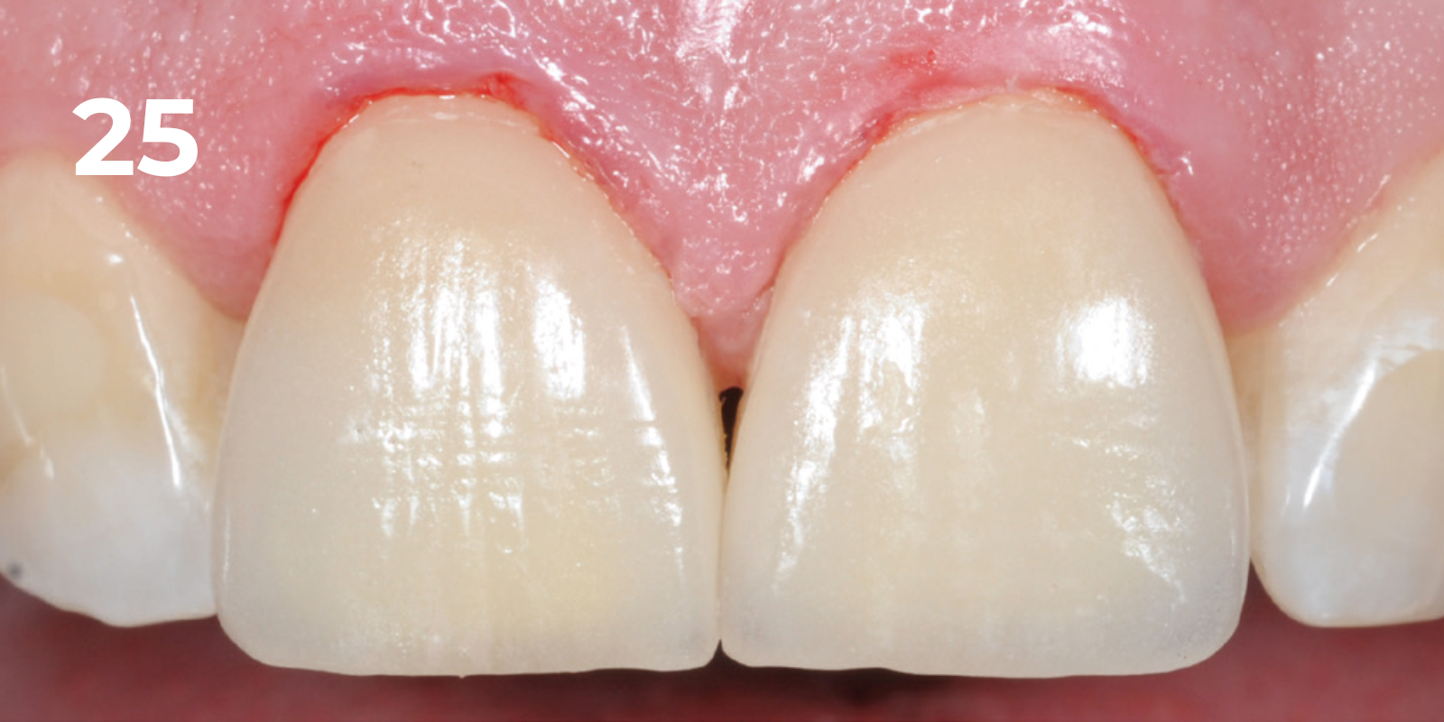 kuraray - panavia v5 - 25.png