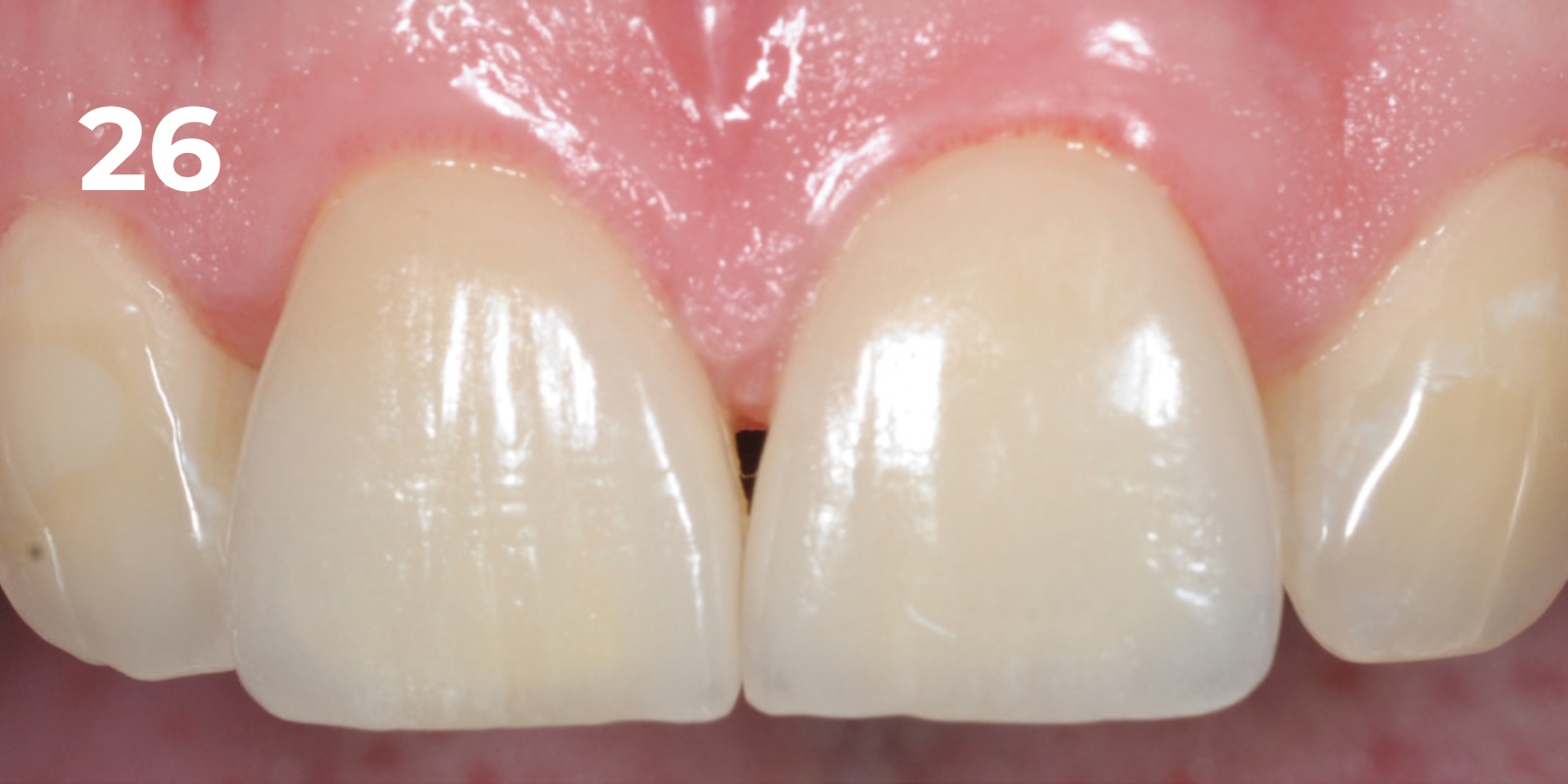 kuraray - panavia v5 - 26.png