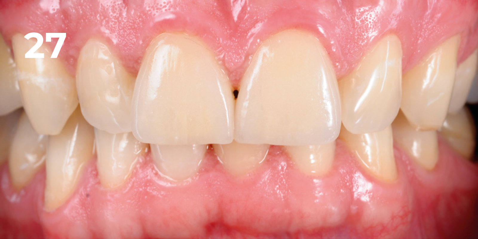 kuraray - panavia v5 - 27.png