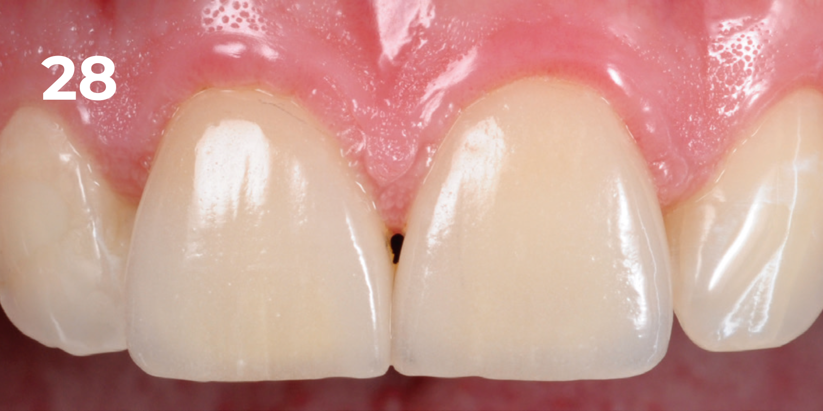 kuraray - panavia v5 - 28.png