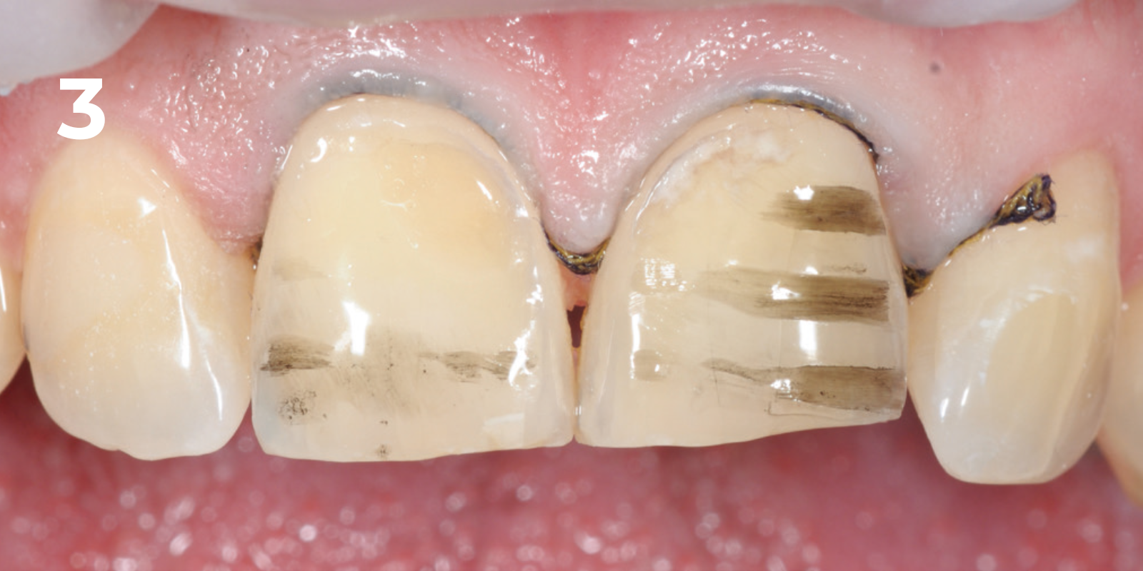 kuraray - panavia v5 - 3.png