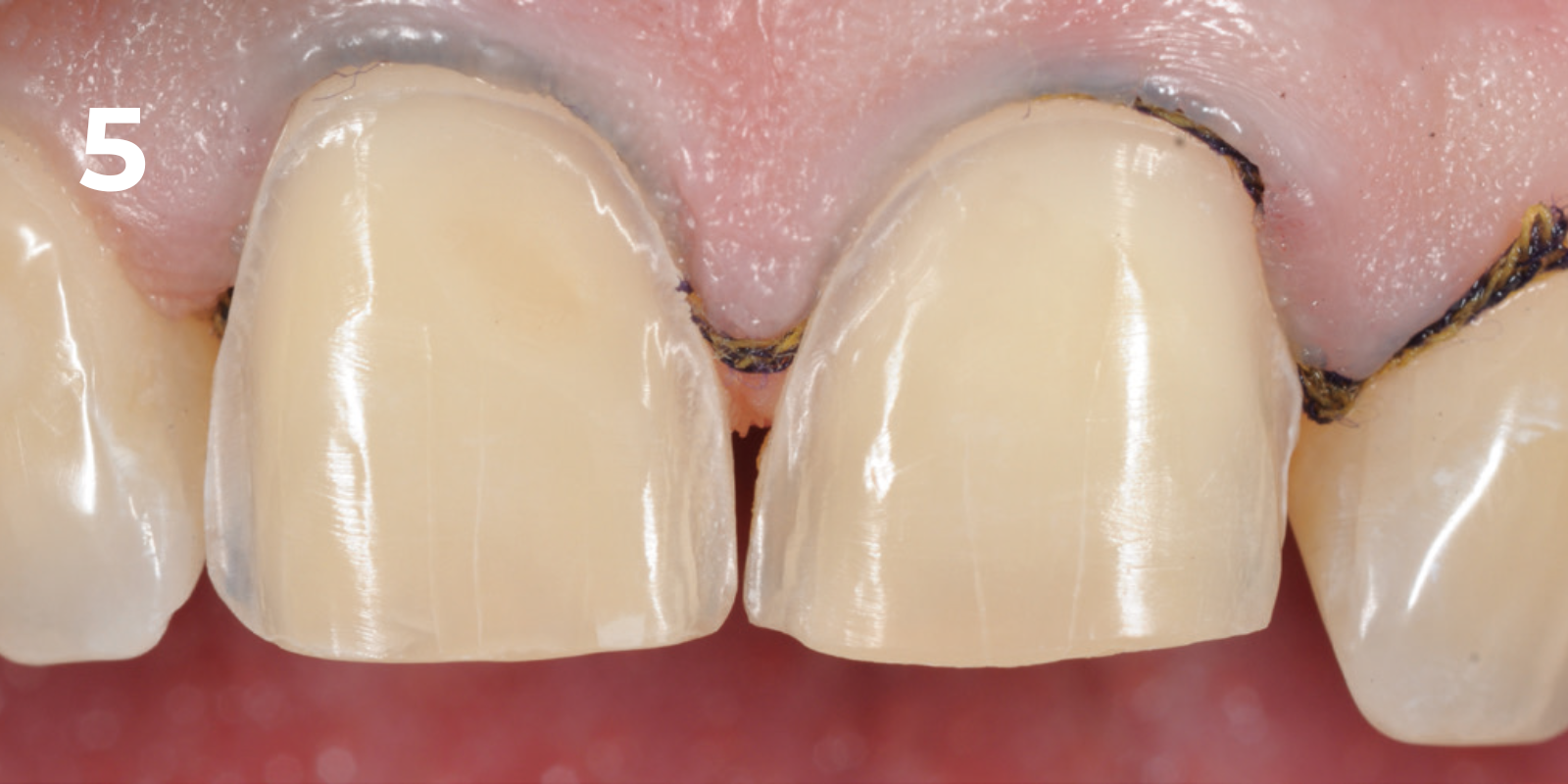 kuraray - panavia v5 - 5.png