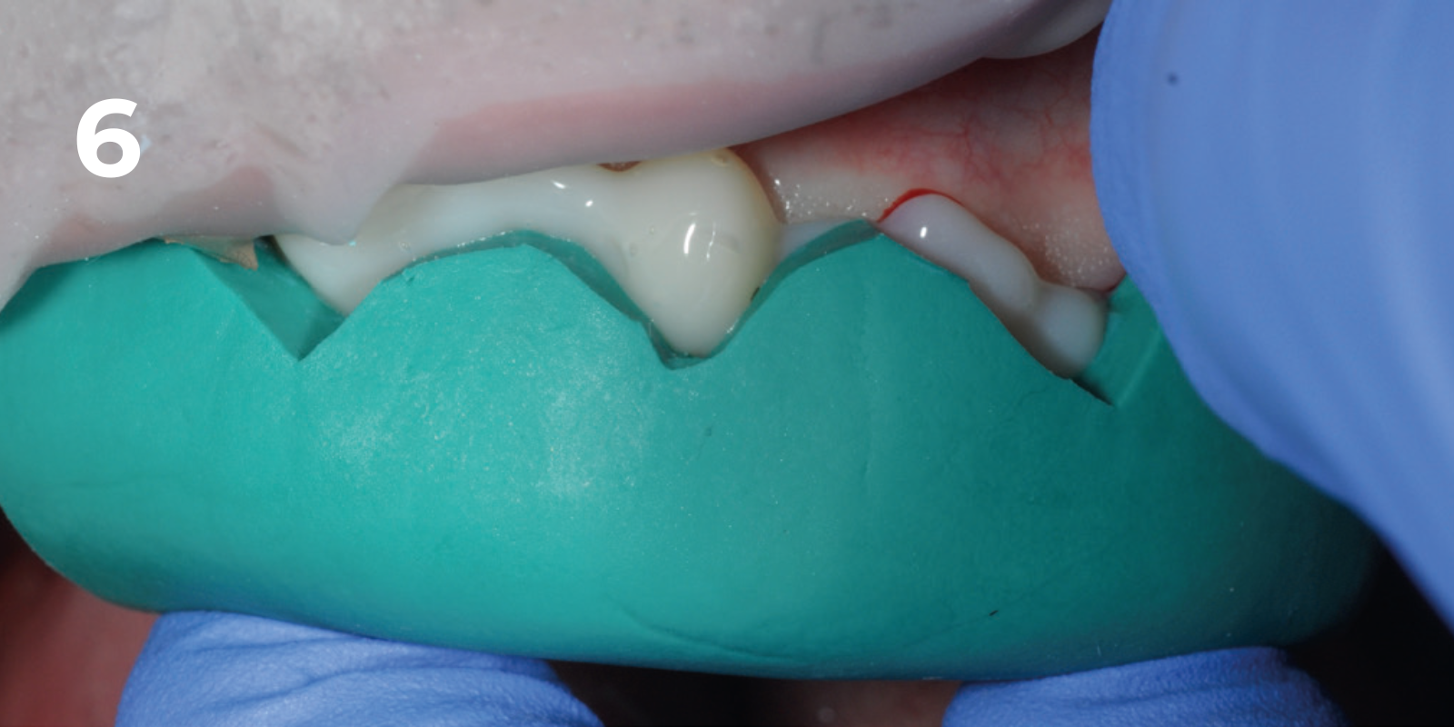 kuraray - panavia v5 - 6.png