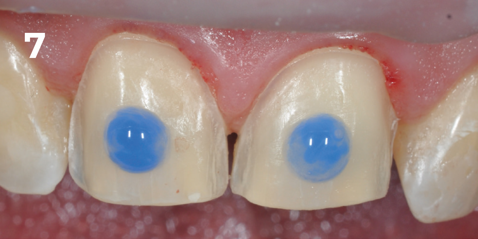 kuraray - panavia v5 - 7.png