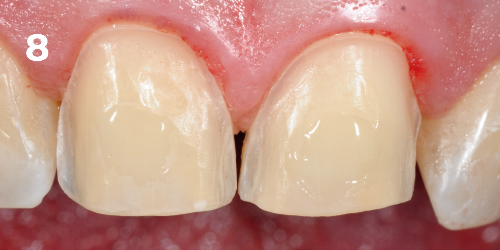 kuraray - panavia v5 - 8.png