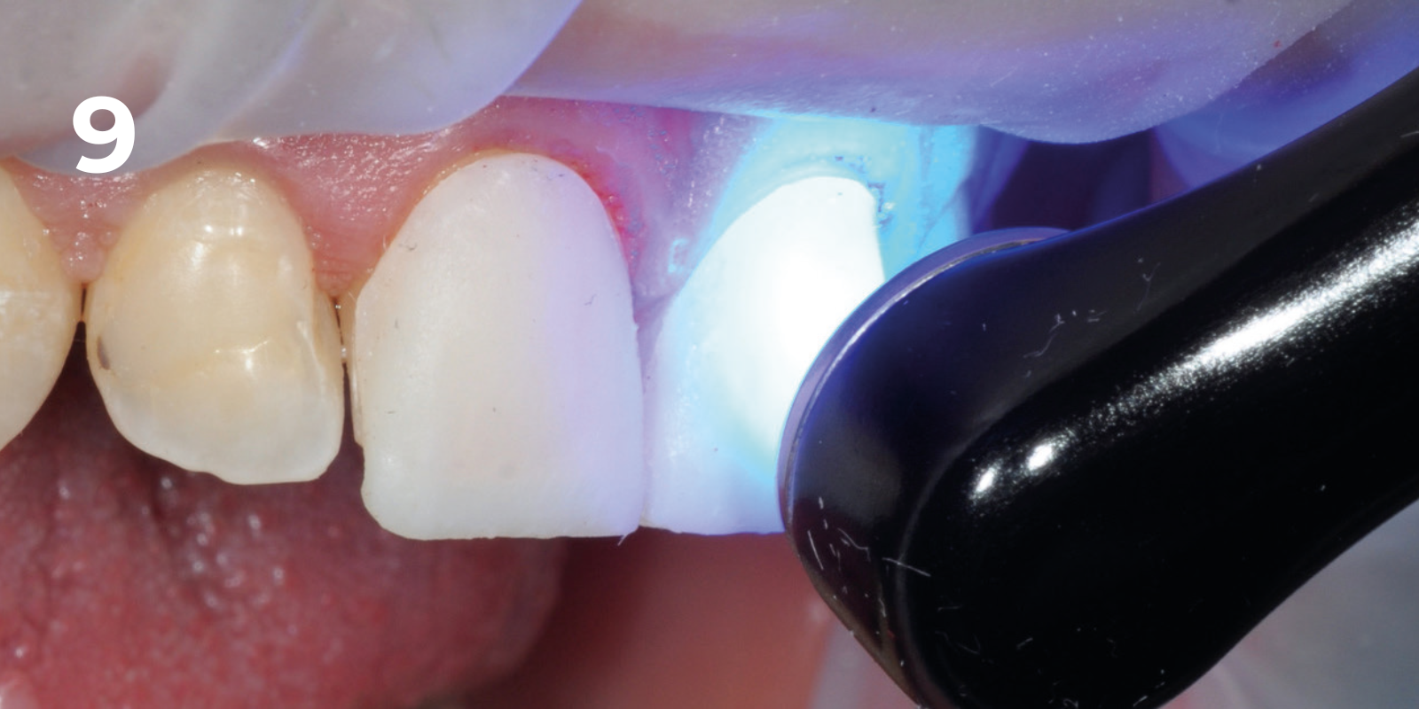 kuraray - panavia v5 - 9.png