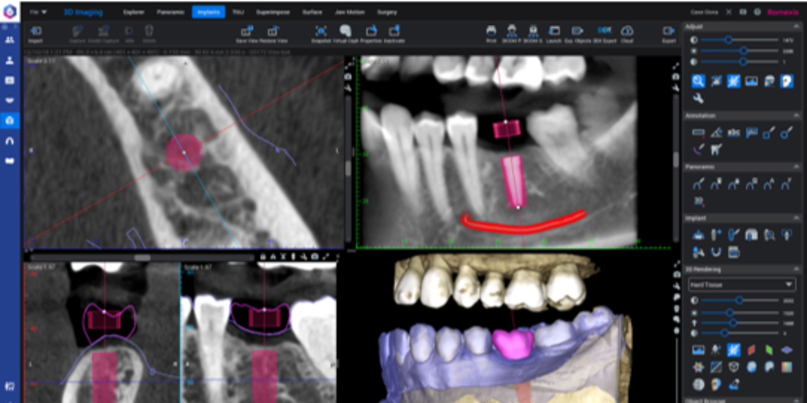 Romexis-implantatbehandling.jpg